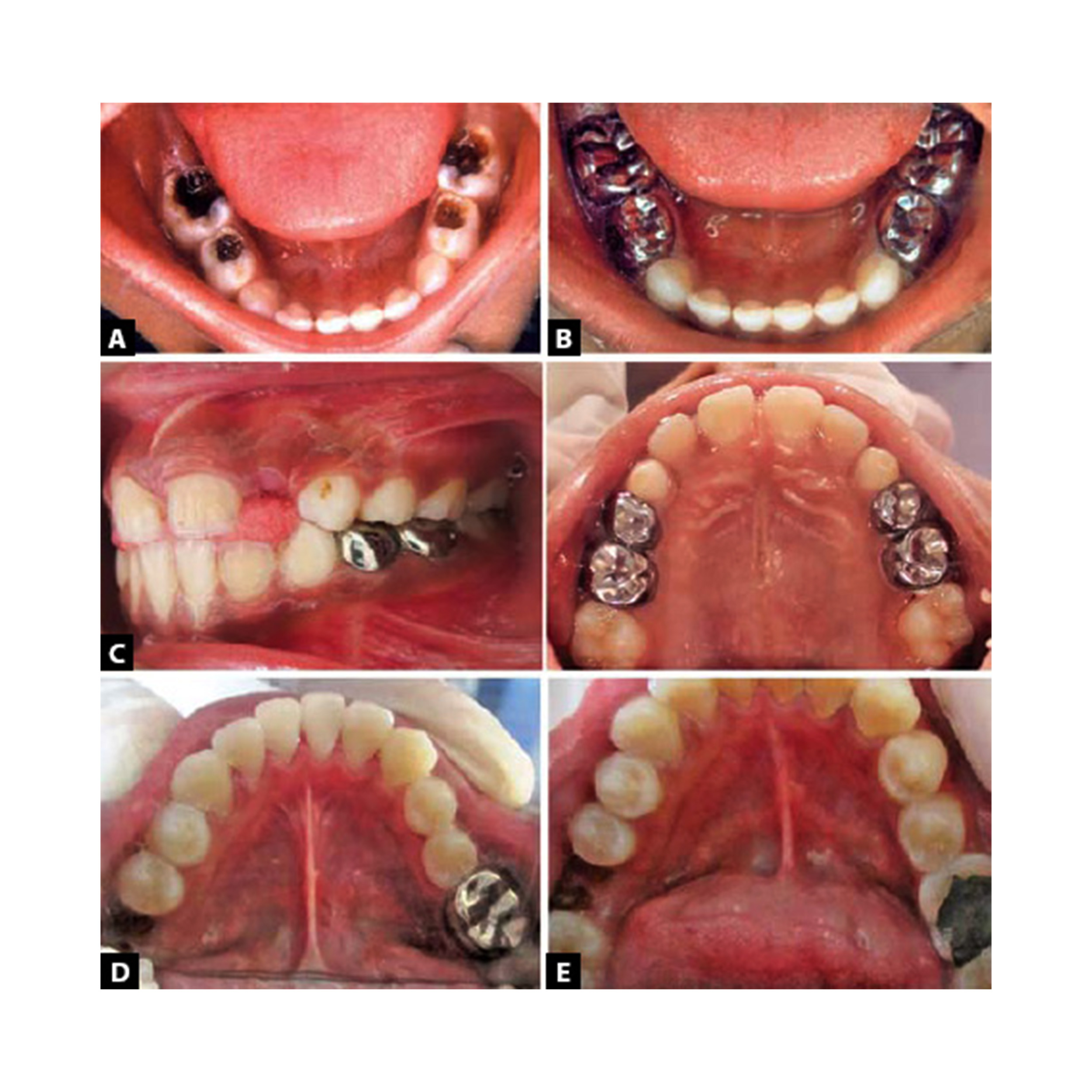 Buy 3M ESPE Stainless Steel Primary Molar Crown ND96 pedo Kit Online at