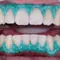 Dental Whitening Material Whiteness HP BLUE