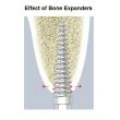 Bone Expander Kit 12pc - Precision