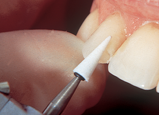 Shofu Dura White Stone CA Dental Finishing Polishing Composite Material