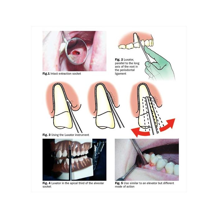 Luxator 1Pc - 3mm Contra Angle #L3CA - Precision