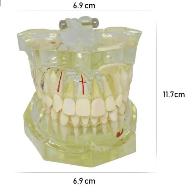 Tooth Study Model For Patient Demonstration